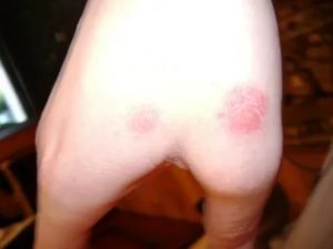 Красное пятно на коже, долго не проходит