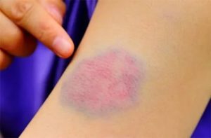 Пятно на руке фиолетового цвета