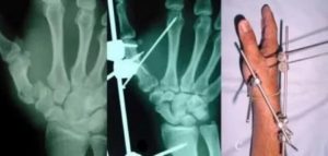 Перелом пятой пястной кости спицы