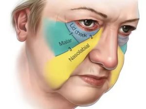 Как убрать отеки с лица