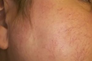 У ребёнка сосудистая сетка на спине