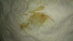 Коричневые выделения через месяц после чистки матки