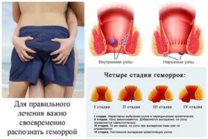 Ничего не помогает от геморроя