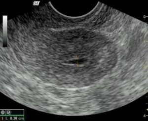 Серозометра при беременности