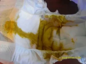 Ребенок не какает третий день