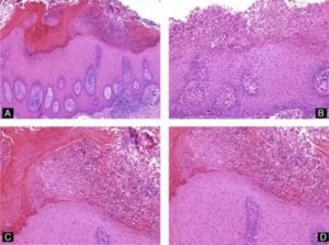 Гиперкератоз вульвы