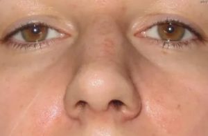 Припухлость возле носа и идёт под глаз после лечения зуба