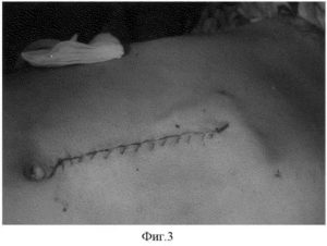 Ревизия раны после операции