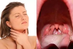 В горле странная шишка, не мешает, хронический тонзиллит