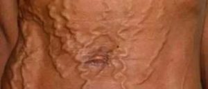 Трещинки на половых губах во время беременности