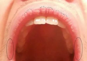 Красные точки во рту на щеке