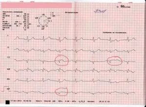 Панические атаки и экстрасистолия