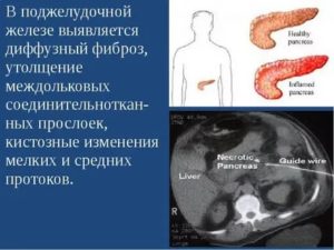 Изменения поджелудочной железы и печени у ребенка