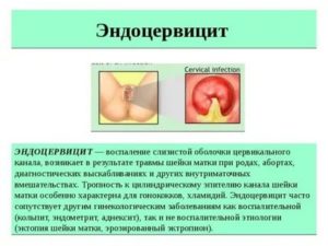 Цитограмма умеренного эндоцервицита