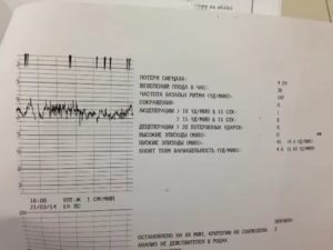 Нормы потери сигнала на ктг?