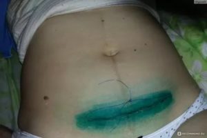 Тянет и болит шов после операции