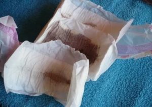 Коричневые выделения через месяц после чистки матки