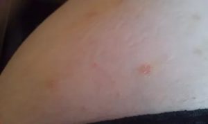 Красные шелушащиеся пятна на теле