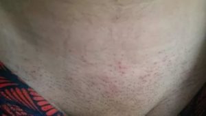 Зуд в области бикини