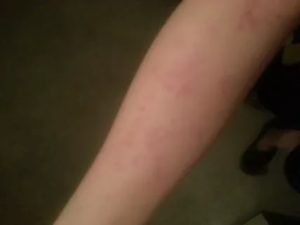 Зуд на внутренней стороне предплечья