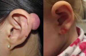 Темно синее образование возле прокола уха