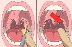 Образования на миндалинах