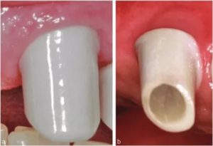 Аллергия на штифты