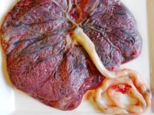 """Рыхлая"" плацента"