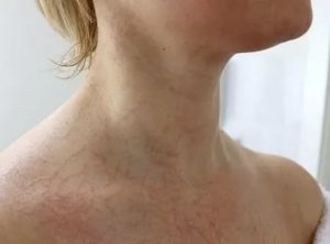 У ребёнка сосудистая сетка на спине