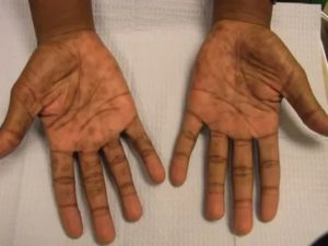 После лечения сифилиса показывают кресты