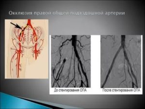 Окклюзия лучевой артерии