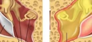 Тонзиллит и отит, воспаление