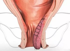 Жжение во влагалище, трещина задней спайки
