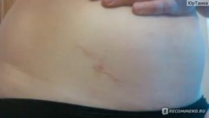 Самостоятельная беременность в первом цикле после лапароскопии