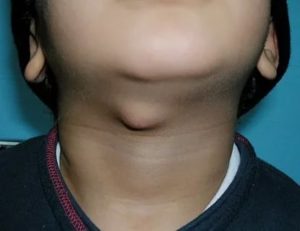 Киста вчп и лимфоузлы шеи