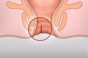 Жжение во влагалище, трещина задней спайки