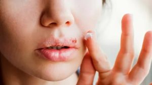 Операция. Герпес