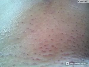 Прыщи на попе у подростка