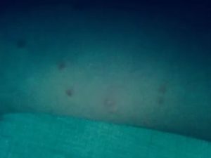 Сыпь, похожая на ветрянку