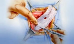 Реабилитация после операции на паховую грыжу