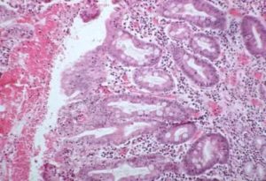 Очаговая метаплазия