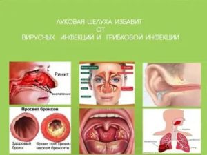 Тонзиллит и отит, воспаление