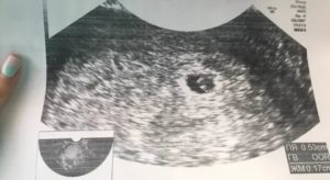 Узи 5 акушерских недель