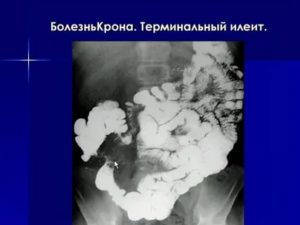 Терминальный илеит