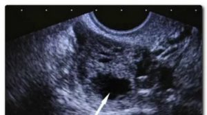 Узи показывет в ячники желтое тело есть ли беременность