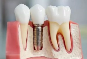 Аллергия на штифты