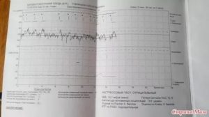 Расшифровка КТГ, оценка по Фишер 8, Кребс 10, нестрессовый тест положительный
