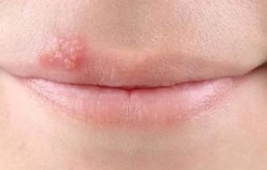 Операция. Герпес