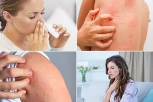 Зуд после приема антибиотиков