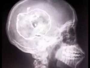 Рентген головы ребенка